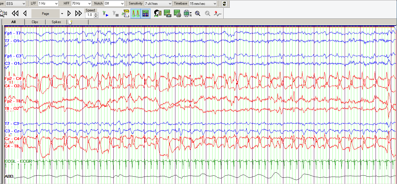 Neonatal seizures neonatal seizure registry